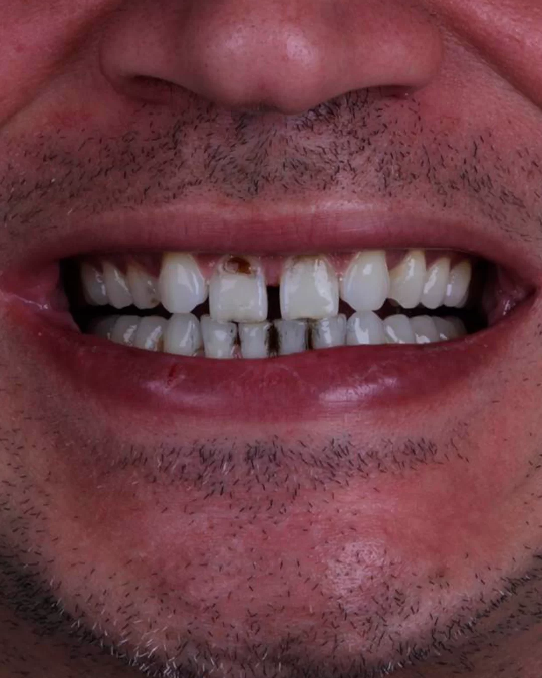 Resultado natural: antes do tratamento