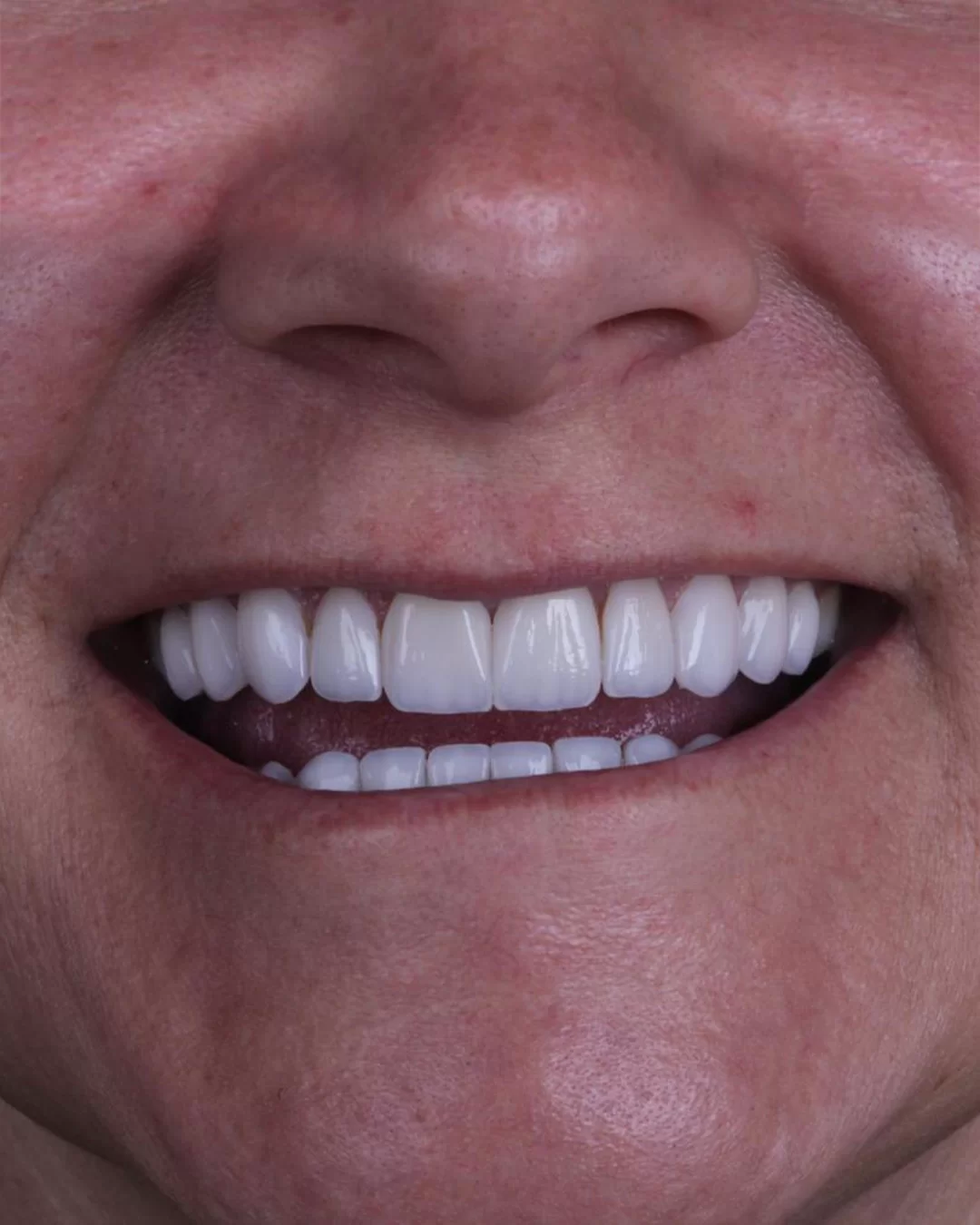 Reabilitação estética: depois do tratamento