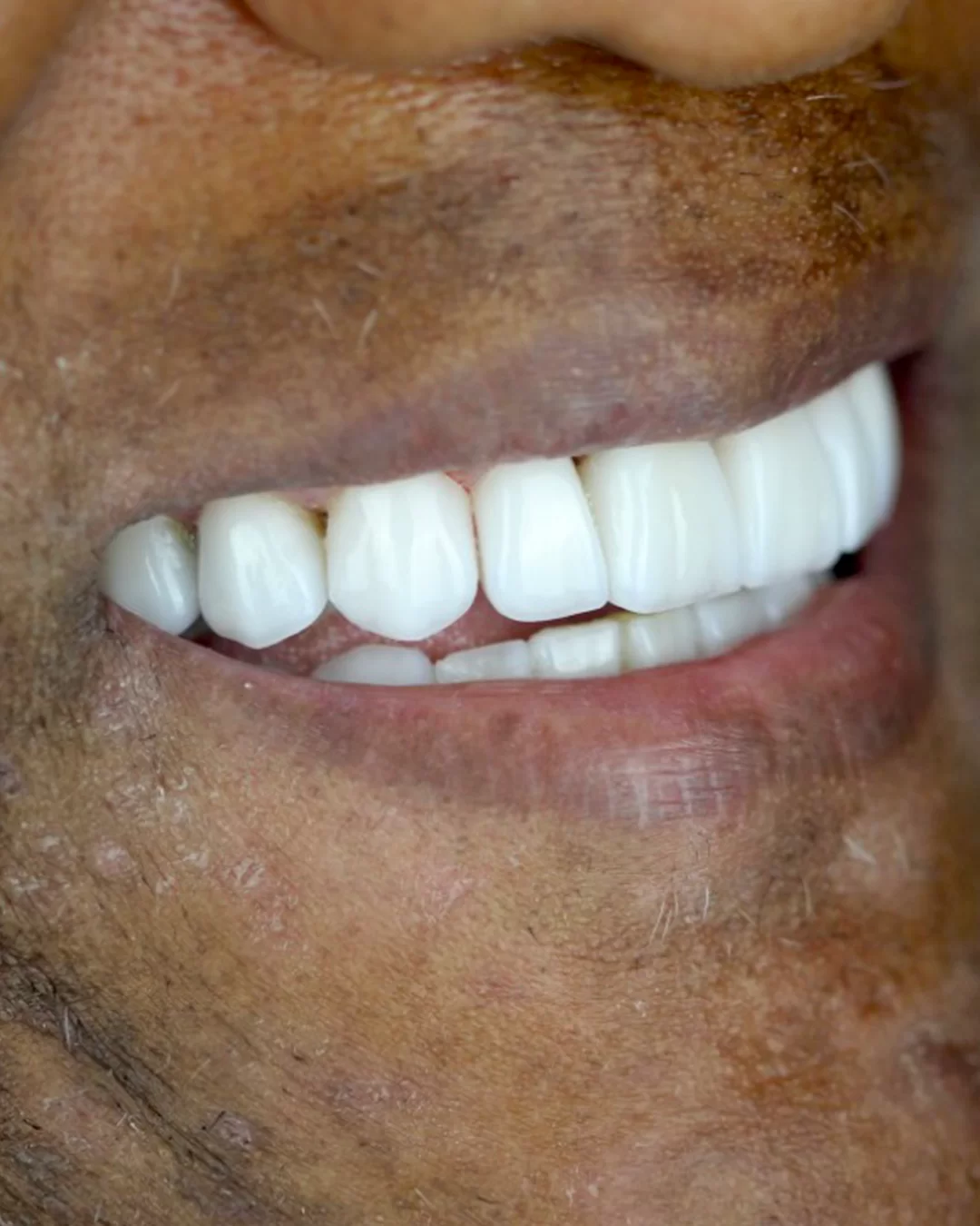 Harmonia do sorriso: depois do tratamento