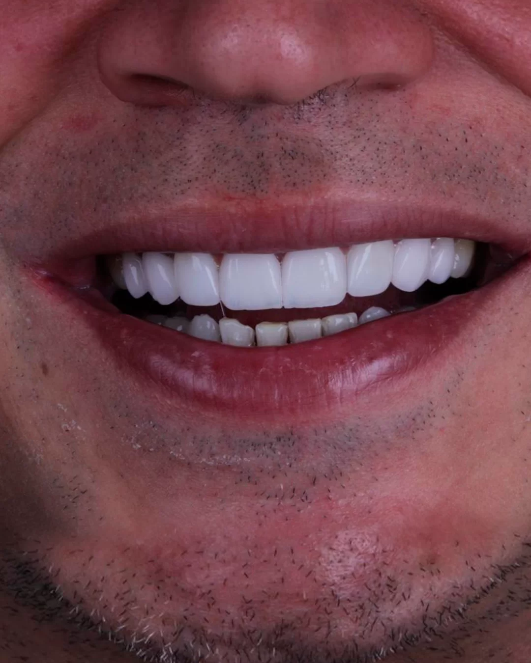 Resultado natural: depois do tratamento